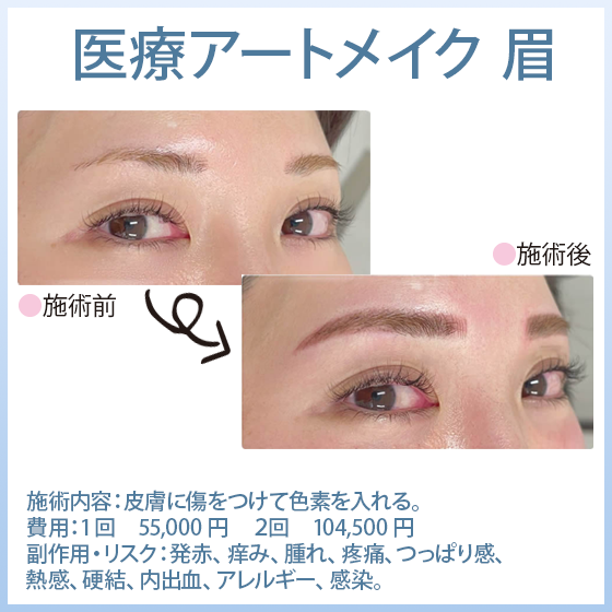 医療アートメイク 眉